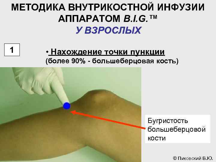 МЕТОДИКА ВНУТРИКОСТНОЙ ИНФУЗИИ АППАРАТОМ B. I. G. ™ У ВЗРОСЛЫХ 1 • Нахождение точки