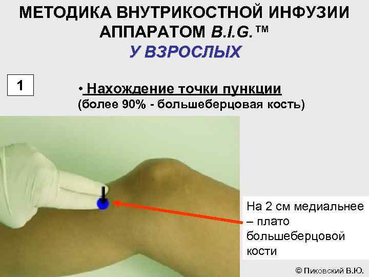 МЕТОДИКА ВНУТРИКОСТНОЙ ИНФУЗИИ АППАРАТОМ B. I. G. ™ У ВЗРОСЛЫХ 1 • Нахождение точки