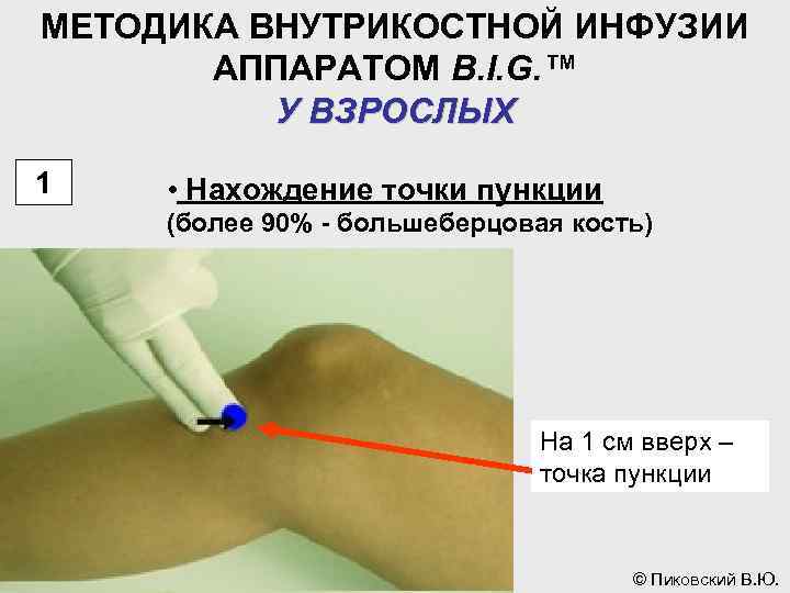 МЕТОДИКА ВНУТРИКОСТНОЙ ИНФУЗИИ АППАРАТОМ B. I. G. ™ У ВЗРОСЛЫХ 1 • Нахождение точки