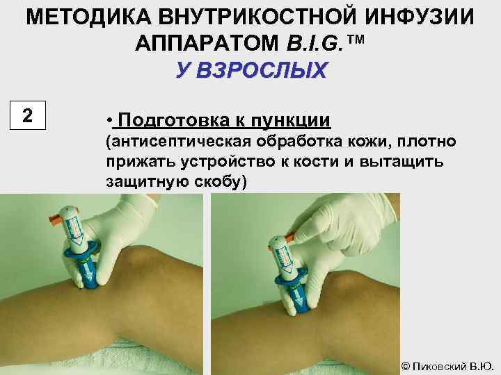 МЕТОДИКА ВНУТРИКОСТНОЙ ИНФУЗИИ АППАРАТОМ B. I. G. ™ У ВЗРОСЛЫХ 2 • Подготовка к