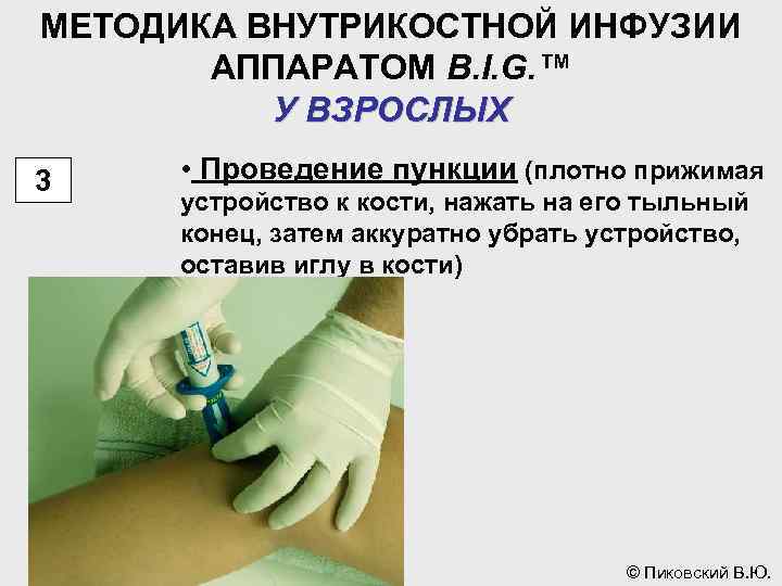 МЕТОДИКА ВНУТРИКОСТНОЙ ИНФУЗИИ АППАРАТОМ B. I. G. ™ У ВЗРОСЛЫХ 3 • Проведение пункции