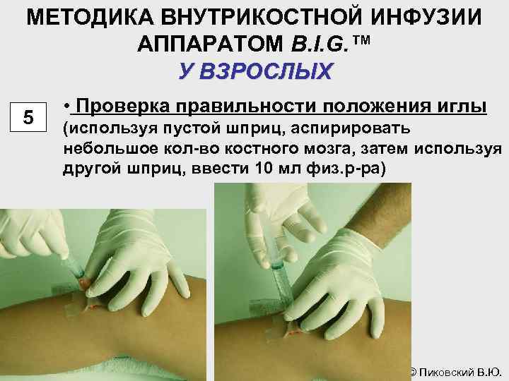 МЕТОДИКА ВНУТРИКОСТНОЙ ИНФУЗИИ АППАРАТОМ B. I. G. ™ У ВЗРОСЛЫХ 5 • Проверка правильности