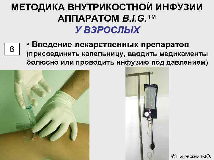 МЕТОДИКА ВНУТРИКОСТНОЙ ИНФУЗИИ АППАРАТОМ B. I. G. ™ У ВЗРОСЛЫХ 6 • Введение лекарственных