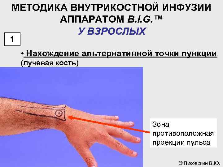 МЕТОДИКА ВНУТРИКОСТНОЙ ИНФУЗИИ АППАРАТОМ B. I. G. ™ У ВЗРОСЛЫХ 1 • Нахождение альтернативной