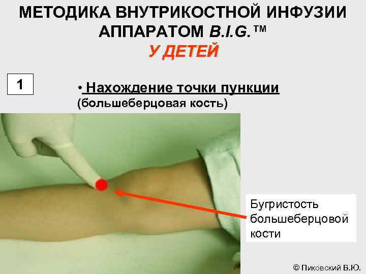 МЕТОДИКА ВНУТРИКОСТНОЙ ИНФУЗИИ АППАРАТОМ B. I. G. ™ У ДЕТЕЙ 1 • Нахождение точки