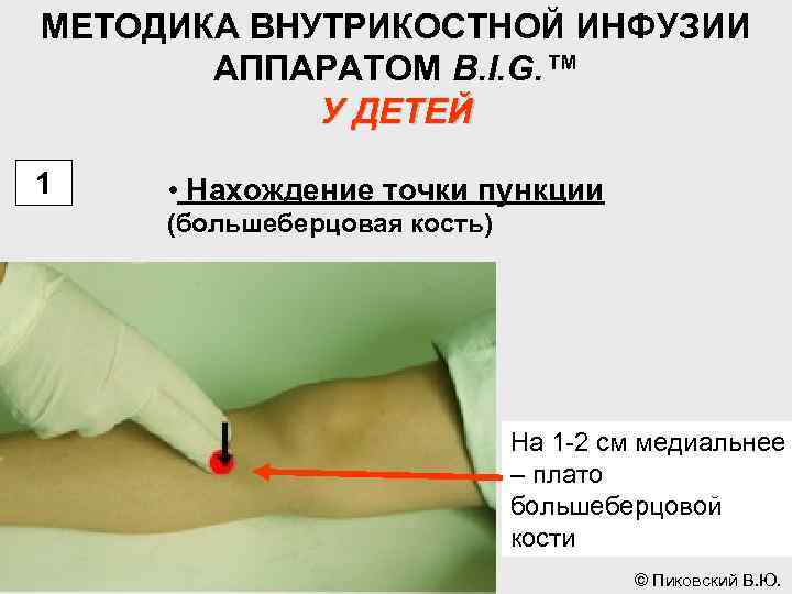 МЕТОДИКА ВНУТРИКОСТНОЙ ИНФУЗИИ АППАРАТОМ B. I. G. ™ У ДЕТЕЙ 1 • Нахождение точки