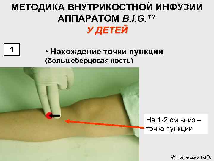 МЕТОДИКА ВНУТРИКОСТНОЙ ИНФУЗИИ АППАРАТОМ B. I. G. ™ У ДЕТЕЙ 1 • Нахождение точки