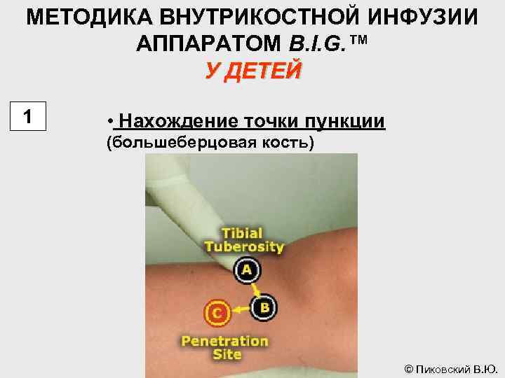 МЕТОДИКА ВНУТРИКОСТНОЙ ИНФУЗИИ АППАРАТОМ B. I. G. ™ У ДЕТЕЙ 1 • Нахождение точки