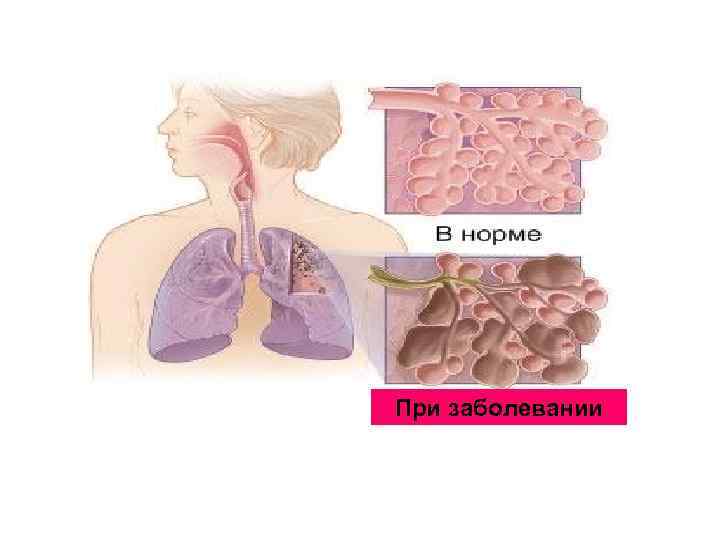 При заболевании 