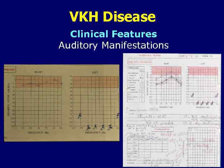 VKH Disease Clinical Features Auditory Manifestations 
