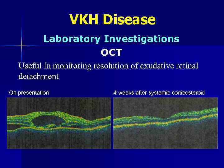 VKH Disease Laboratory Investigations OCT Useful in monitoring resolution of exudative retinal detachment On