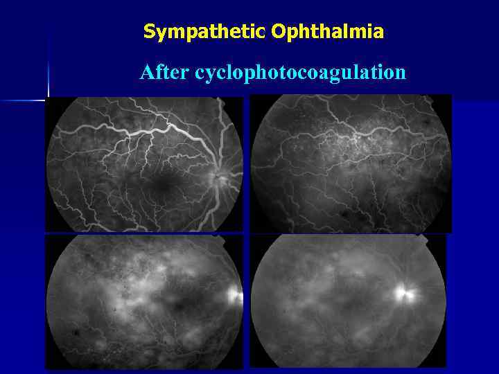 Sympathetic Ophthalmia After cyclophotocoagulation 