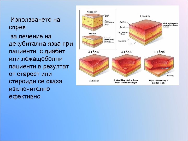 Използването на спрея за лечение на декубитална язва при пациенти с диабет или лежащоболни
