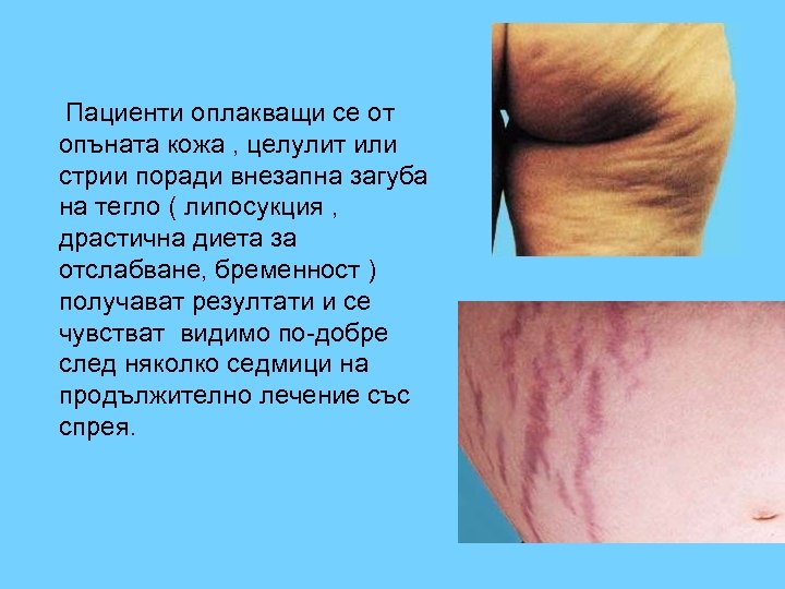 Пациенти оплакващи се от опъната кожа , целулит или стрии поради внезапна загуба на