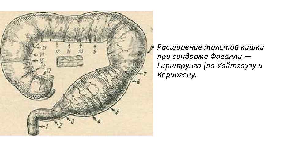 Дивертикул меккеля у детей презентация