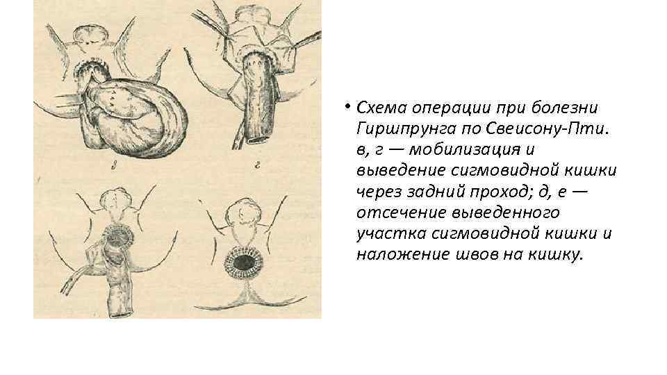  • Схема операции при болезни Гиршпрунга по Свеисону-Пти. в, г — мобилизация и