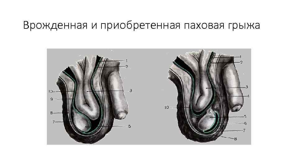 Врожденная и приобретенная паховая грыжа 