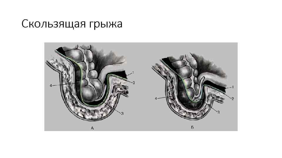 Дивертикул меккеля у детей презентация