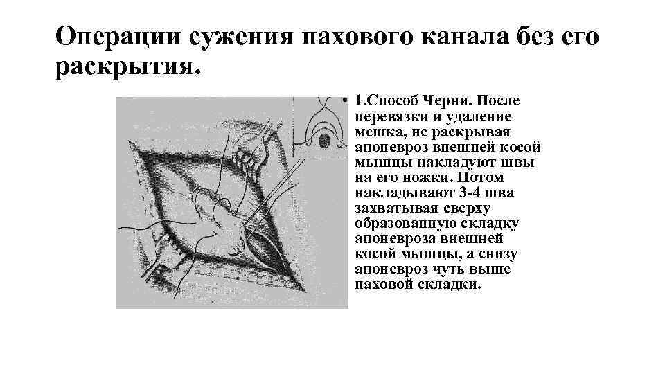 Дивертикул меккеля у детей презентация