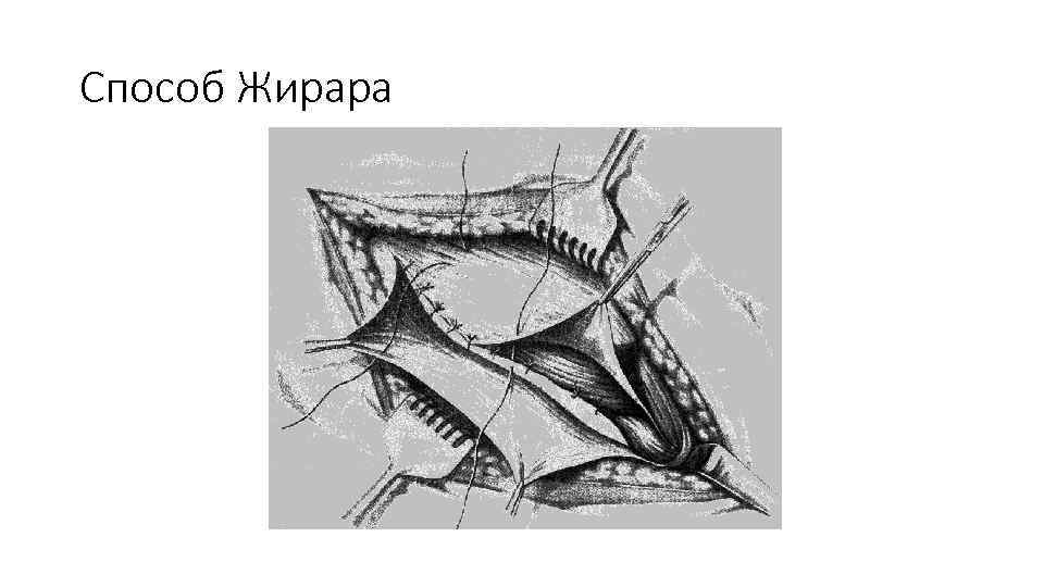 Дивертикул меккеля у детей презентация