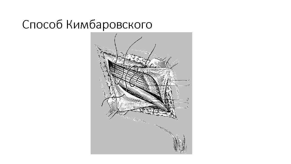 Дивертикул меккеля у детей презентация