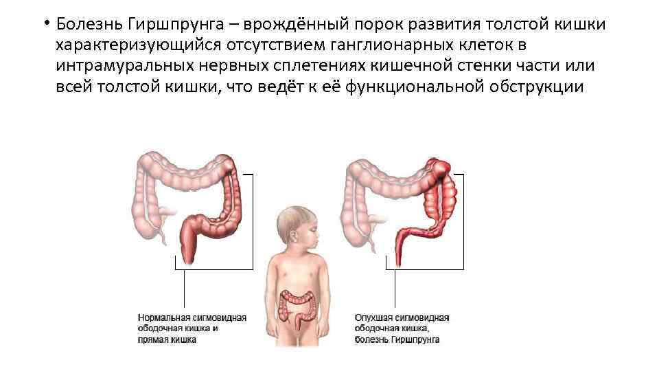  • Болезнь Гиршпрунга – врождённый порок развития толстой кишки характеризующийся отсутствием ганглионарных клеток