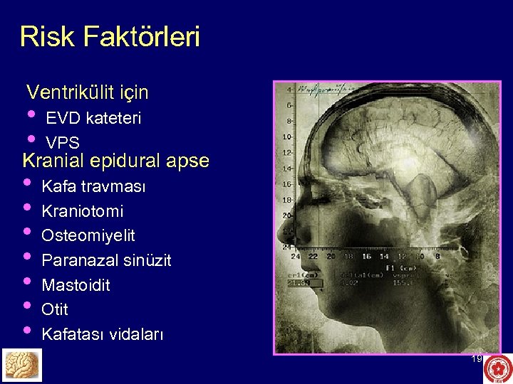 Risk Faktörleri Ventrikülit için • • EVD kateteri VPS • • Kafa travması Kraniotomi