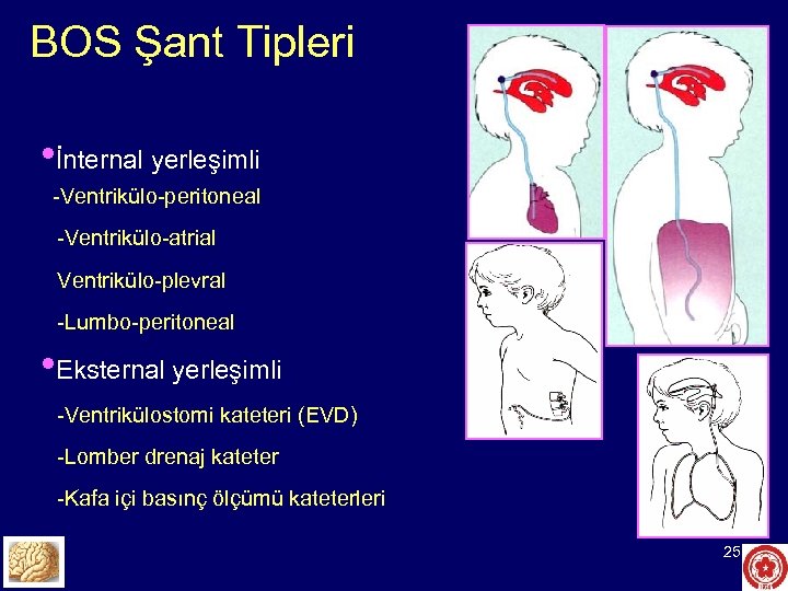 BOS Şant Tipleri • İnternal yerleşimli -Ventrikülo-peritoneal -Ventrikülo-atrial Ventrikülo-plevral -Lumbo-peritoneal • Eksternal yerleşimli -Ventrikülostomi
