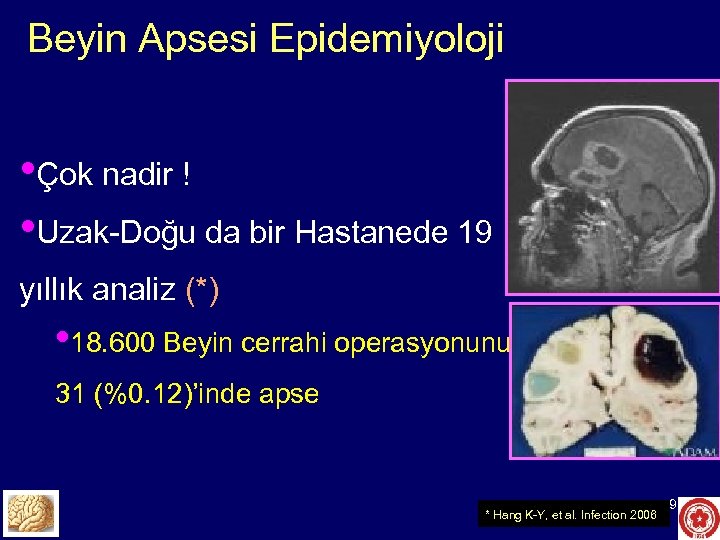 Beyin Apsesi Epidemiyoloji • Çok nadir ! • Uzak-Doğu da bir Hastanede 19 yıllık