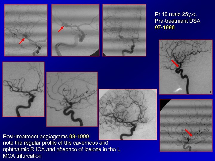 Pt 10 male 25 y. o. Pre-treatment DSA 07 -1998 Post-treatment angiograms 03 -1999: