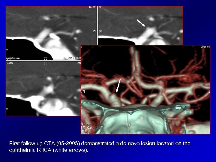 First follow up CTA (05 -2005) demonstrated a de novo lesion located on the