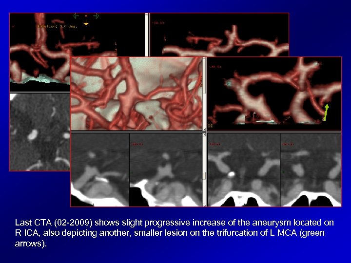 Last CTA (02 -2009) shows slight progressive increase of the aneurysm located on R