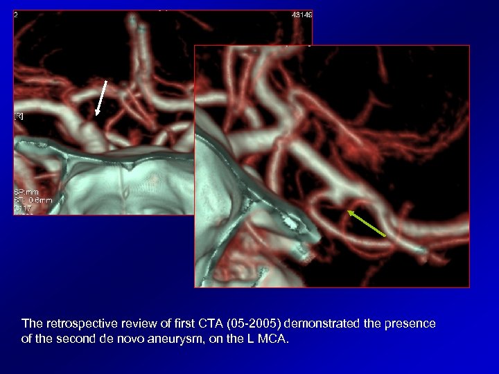 The retrospective review of first CTA (05 -2005) demonstrated the presence of the second
