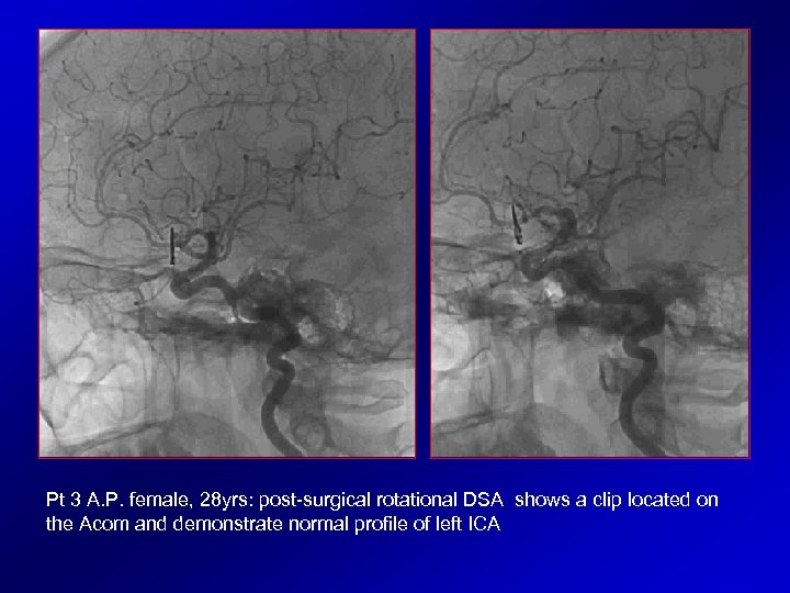 Pt 3 A. P. female, 28 yrs: post-surgical rotational DSA shows a clip located