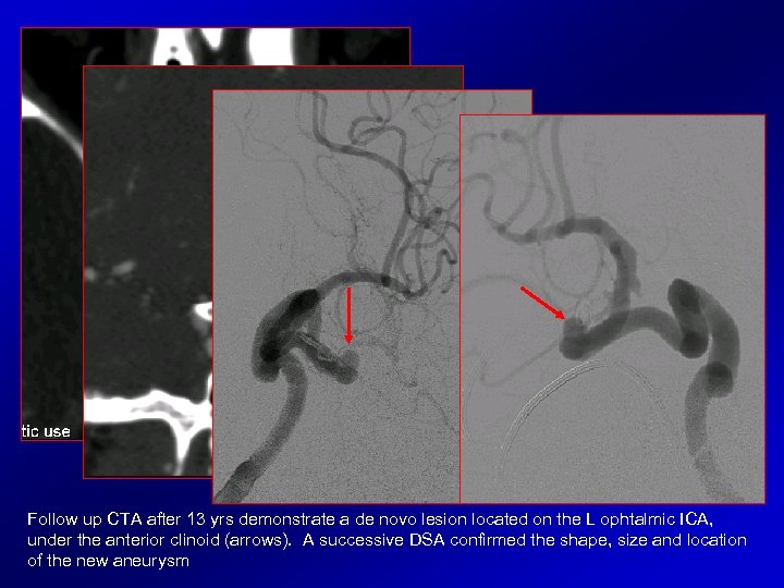Follow up CTA after 13 yrs demonstrate a de novo lesion located on the