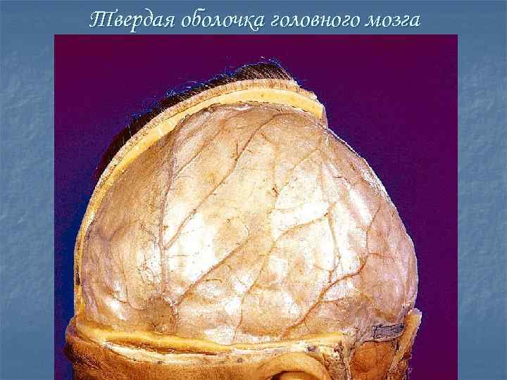 Твердая оболочка головного мозга 