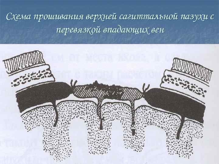 Схема прошивания верхней сагиттальной пазухи с перевязкой впадающих вен 