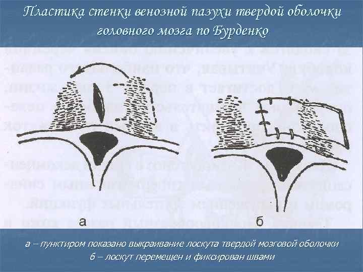 Пластика стенок. Пластика синуса твёрдой мозговой оболочки по Бурденко. Пластика твердой мозговой оболочки по Добротворскому. Пластика по Бурденко твердой мозговой оболочки. Замещение дефектов твердой оболочки головного мозга по Бурденко.