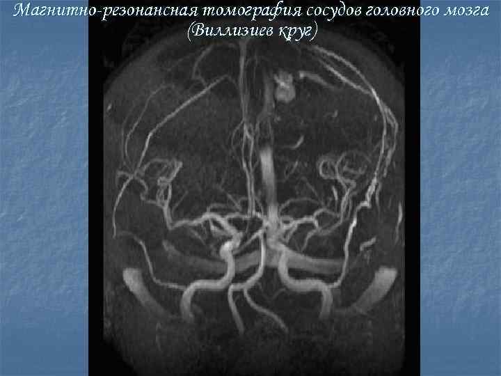 Магнитно-резонансная томография сосудов головного мозга (Виллизиев круг) 