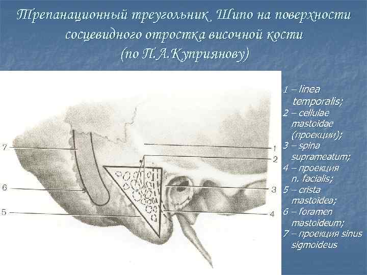 Трепанационный треугольник шипо схема