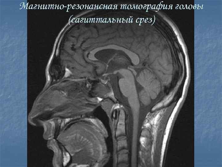Магнитно-резонансная томография головы (сагиттальный срез) 