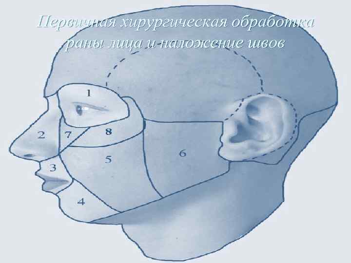 Первичная хирургическая обработка раны лица и наложение швов 