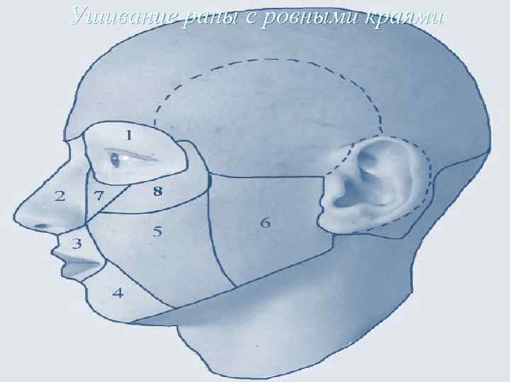 Ушивание раны с ровными краями 
