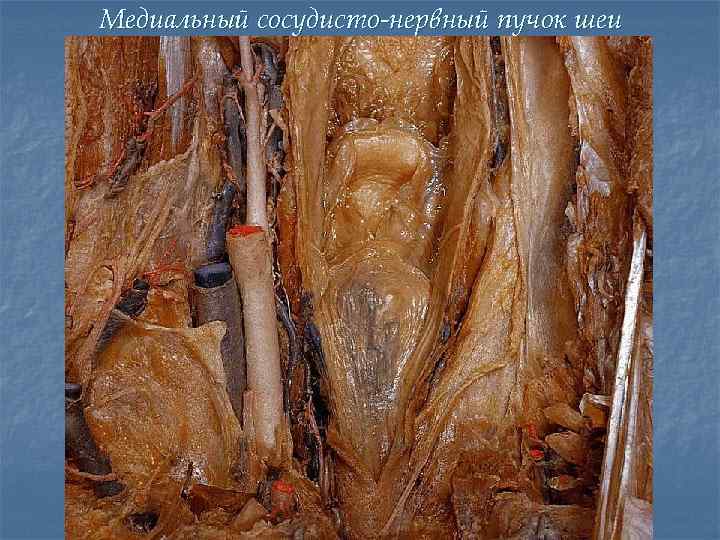 Медиальный сосудисто-нервный пучок шеи 