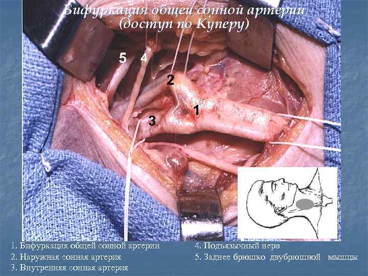 Бифуркация общей сонной артерии (доступ по Куперу) 5 4 2 3 1. Бифуркация общей