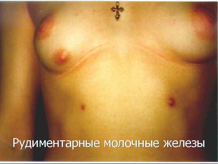 Рудиментарные молочные железы 