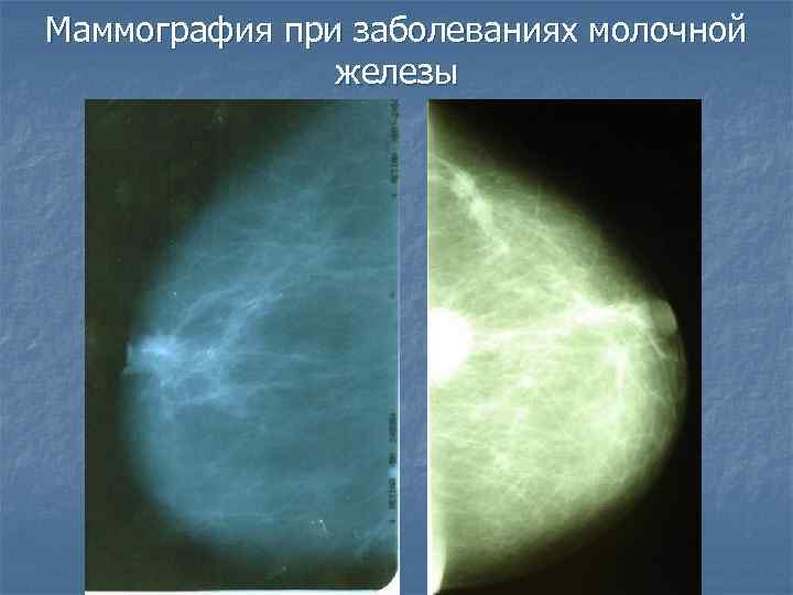 Маммография при заболеваниях молочной железы 