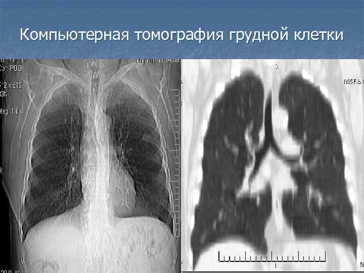 Компьютерная томография грудной клетки 