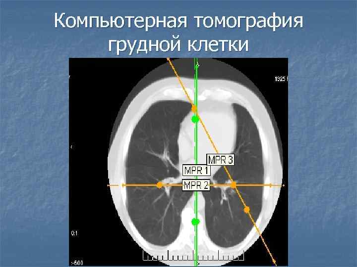 Компьютерная томография грудной клетки 