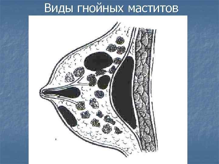 Виды гнойных маститов 